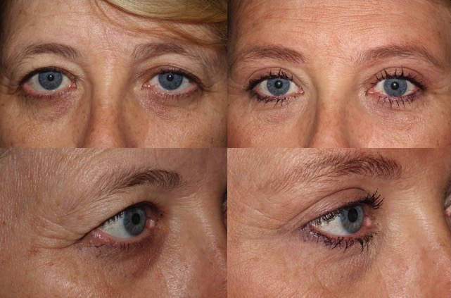 Brow lift, blepharoplasty both bilateral and ptosis repair left - Dr Guy Massry - Beverly Hills